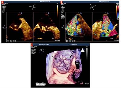 Case Report: Streptococcus alactolyticus as a Rare Pathogen of Mitral Endocarditis